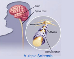 multiple sclerosis