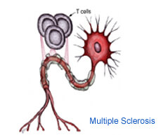 multiple sclerosis