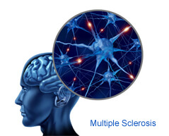 multiple sclerosis