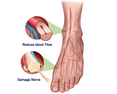 peripheral neuropathy