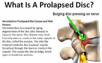 prolapse disc