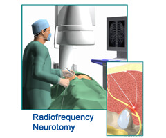 radiofrequency neurotomy procedure in india