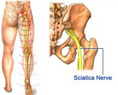 Sciatica surgery in india