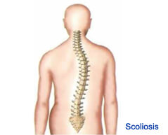 scoliosis surgery in india