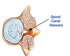 Spinal Stenosis surgery in india