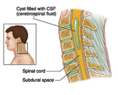 spinal tumors surgery