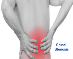 Spinal Stenosis surgery in india