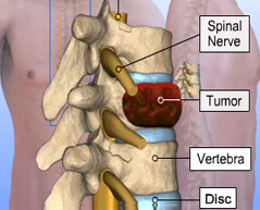 spinal tumors surgery