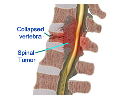 Spinal Tumors treatment in india