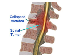 spinal tumors surgery