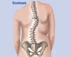 scoliosis treatment in india