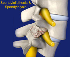 Spondylolisthesis - Spondylolysis