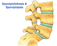 Spondylolisthesis - Spondylolysis surgery in india