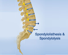Spondylolisthesis - Spondylolysis surgery in india