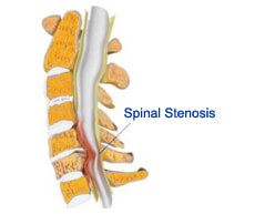 Spinal Stenosis treatment in india