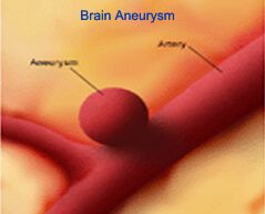 top brain aneurysm treatment hospitals best specialists India