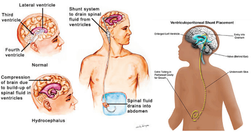 ventriculoperitoneal shunt for hydrocephalus