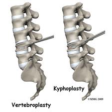 vertebroplasty and kyphoplasty treatment india