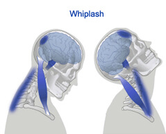 Whiplash surgery in india