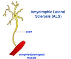 Chirurgie abordable de la sclérose latérale amyotrophique en Inde