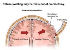 Affordable Craniectomy Surgery in India