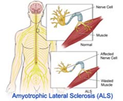 Amyotrophic Lateral Sclerosis Surgery Cost in India
