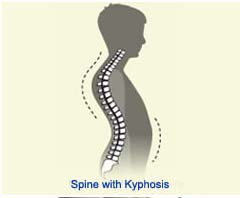 Best Hospital for Kyphosis Treatment India