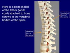 Cost Benefits of Vertebral Body Tethering Surgery in India