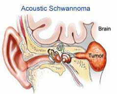 Cost Effective Brain Tumor Treatment in India