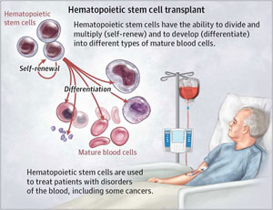 haematopoietic stem cell transplantation for multiple sclerosis in india