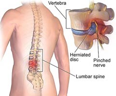 Herniated Disc Surgery Cost in India