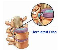 ভারতে হার্নিয়েটেড ডিস্ক সার্জারি