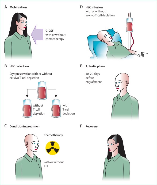 How is Haematopoietic Stem Cell Transplantation done?