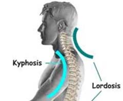 Kyphosis Treatment Cost in India