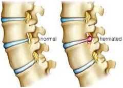 Low Cost Herniated Disc Surgery in India