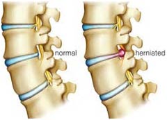ভারতে কম খরচে হার্নিয়েটেড ডিস্ক সার্জারি