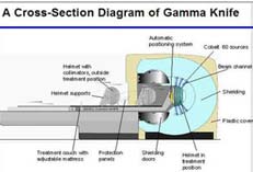 Prix le plus bas pour le traitement de radiochirurgie gamma-couteau en Inde