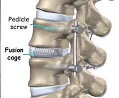 Lowest Price for Spinal Fusion Surgery Treatment in India