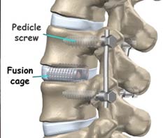 Prix le plus bas pour le traitement de chirurgie de fusion spinale en Inde